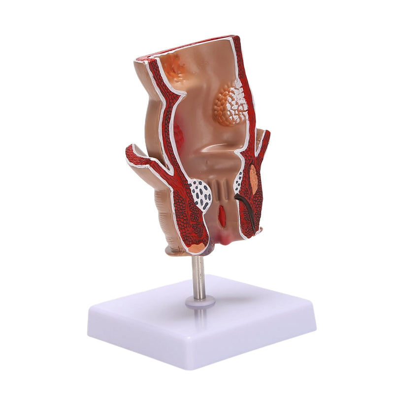 Anatomy Model Human Rectal Hemorrhoid Lesion Model Pathology Teaching Model