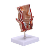 Anatomy Model Human Rectal Hemorrhoid Lesion Model Pathology Teaching Model