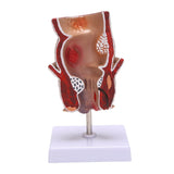Anatomy Model Human Rectal Hemorrhoid Lesion Model Pathology Teaching Model