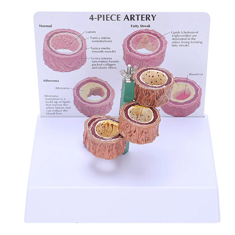 Atherosclerosis Thrombosis Model Heart Vascular Pathology Demo